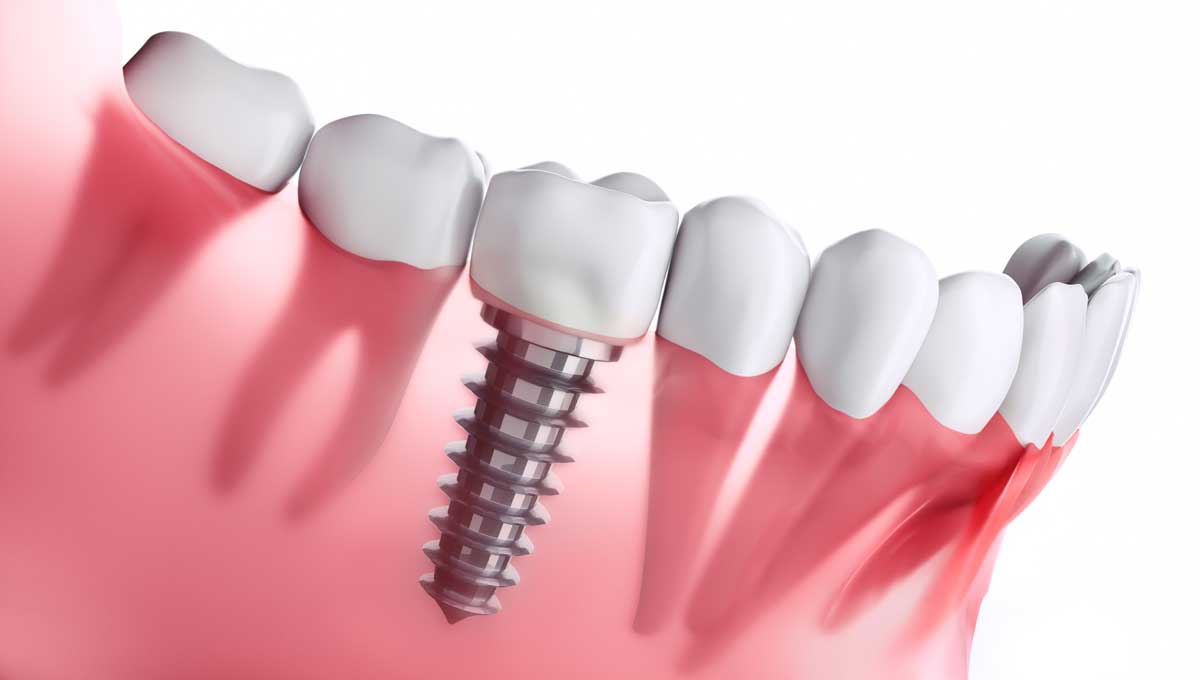 Implantate vom Zahnarzt in Bergneustadt